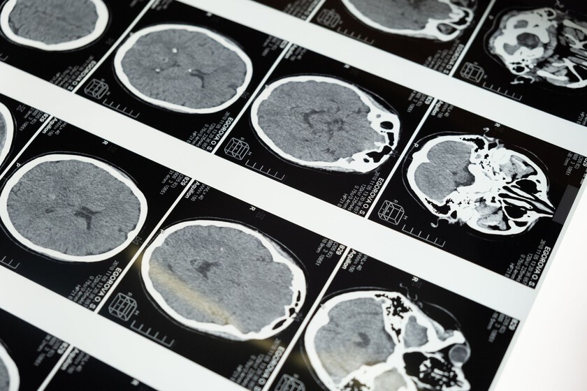 No es solo cuestión de cumplir años: la mala salud metabólica envejece tu cerebro por una vía completamente independiente