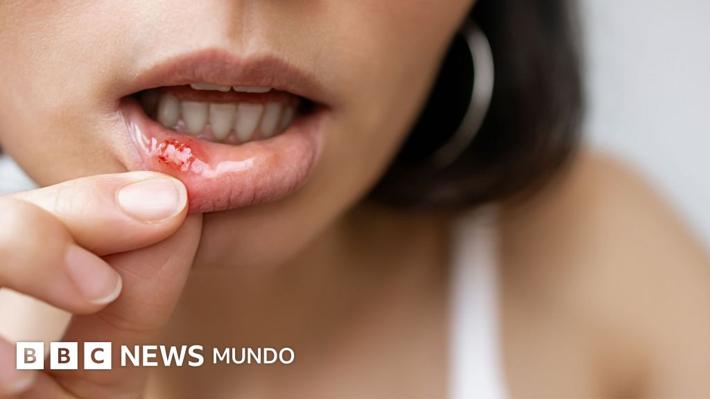 Por qué nos salen úlceras en la boca y qué puedes hacer para aliviar sus síntomas