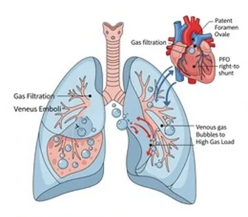 Risks of Decompression Sickness and Venous Thromboembolism during Spaceflight and Patent Foramen Ovale Implications