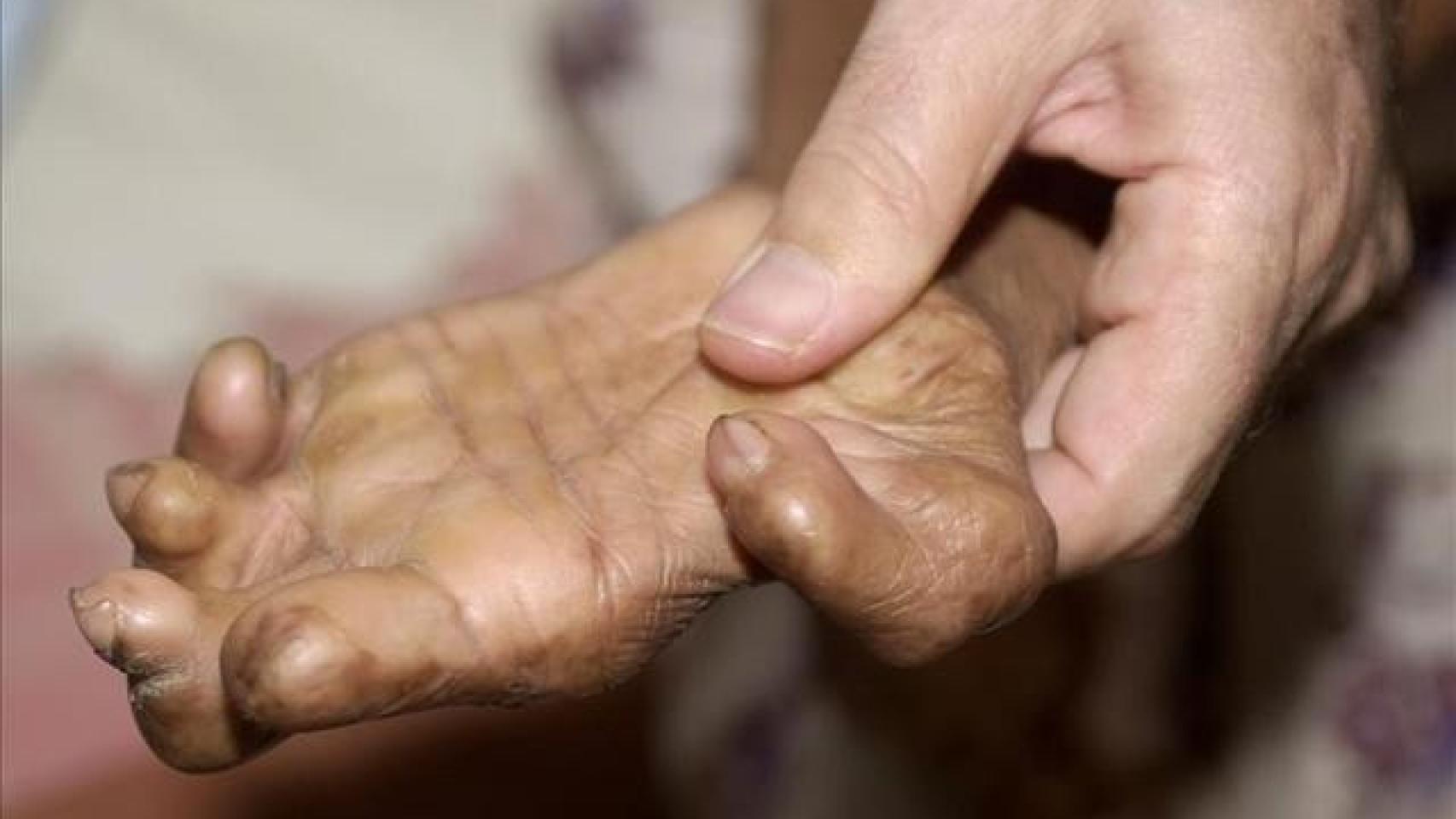 La lepra sigue viva en España con más de 100 casos en 10 años: Andalucía, Madrid y Cataluña encabezan la lista