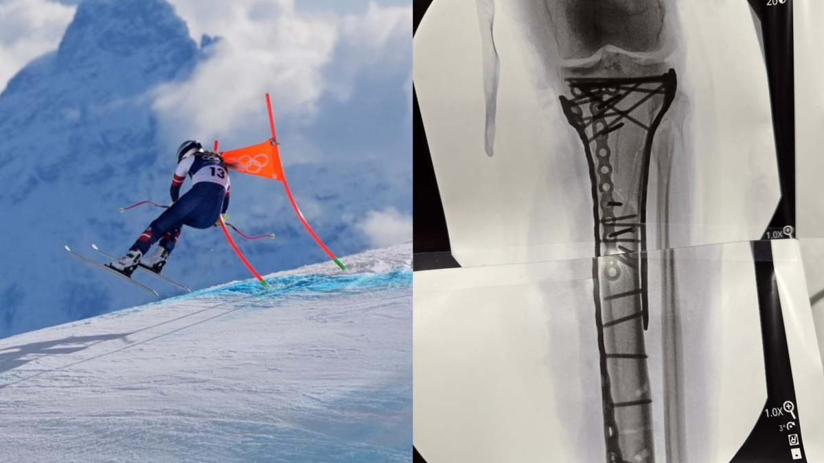 Estremecedor relato de Lindsey Vonn: "Él abrió el músculo, lo dejó respirar y me salvó"<br>