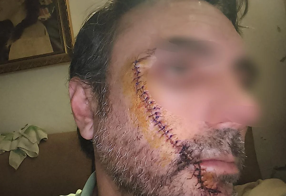 Jorge, el hombre al que rajaron la cara en Málaga: «Si no llego a ver el reflejo del cuchillo, me mata»