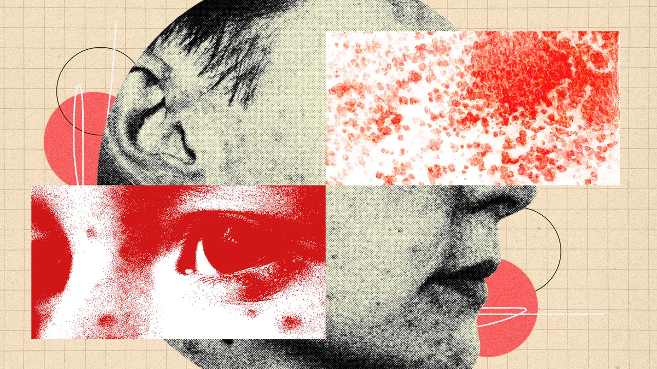 Herpes zóster: por qué la reactivación de tu antigua varicela es tan peligrosa