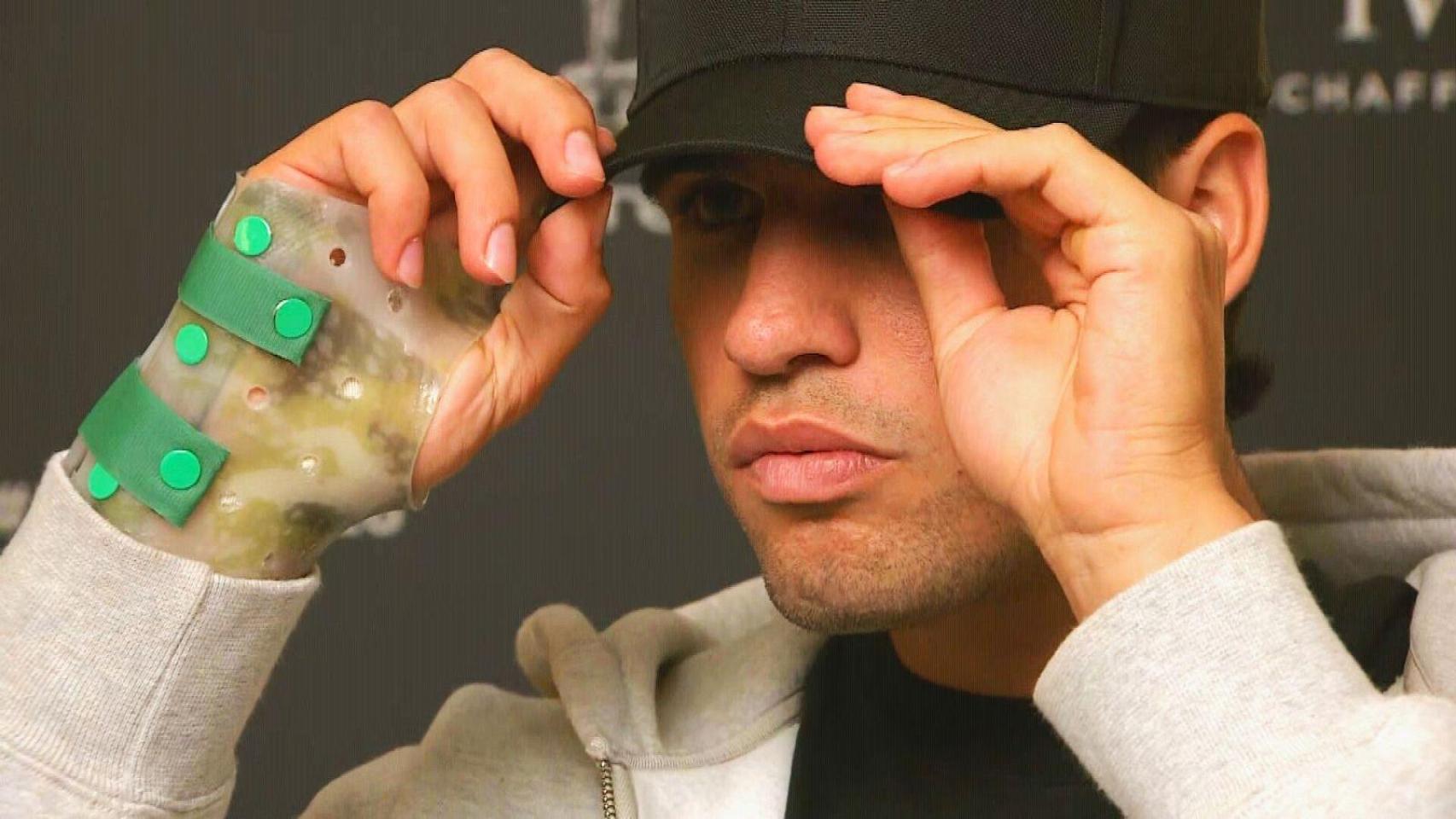 La prudencia de Alcaraz frente a una lesión seria: Wimbledon en riesgo y el espejo de otras carreras rotas por la muñeca