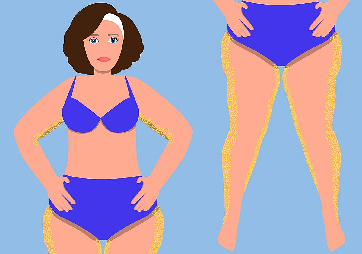 Esa grasa que se acumula en las piernas... ¿Es celulitis o lipedema?